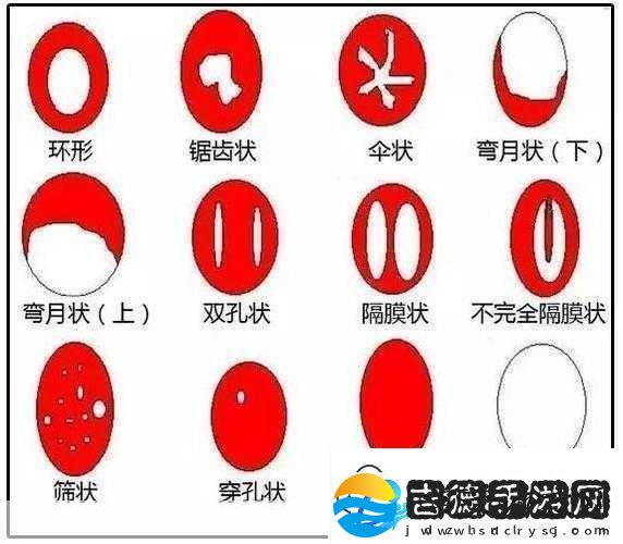 阴脣肥大的图示蝴蝶